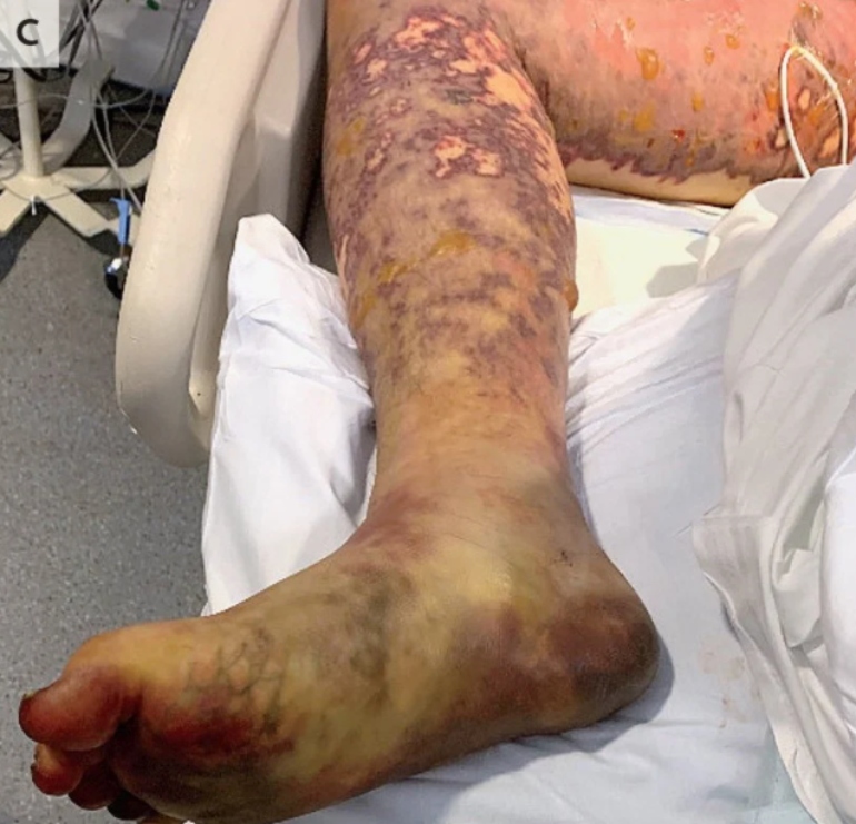 Jovem tem pernas amputadas após infecção por bactéria