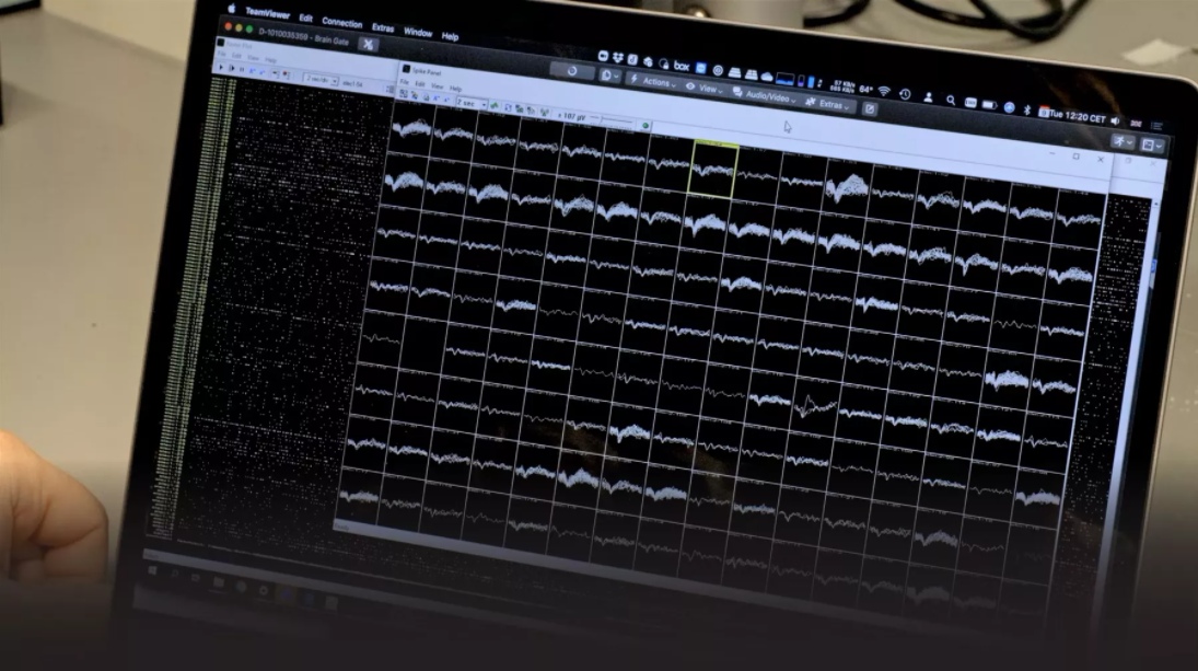 Monitor com sinais cerebrais captados por microeletrodos implantados no paciente