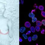 Cientistas desenvolvem injeção contra câncer de mama