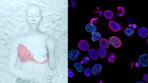 Cientistas desenvolvem injeção contra câncer de mama