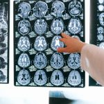 Uma pesquisa britânica criou uma nova inteligência artificial que poderá diagnosticar a Doença de Alzheimer em um só simples exame