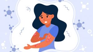 Monkeypox, alergia, herpes ou picada de inseto? Saiba diferenciar as irritações na pele
