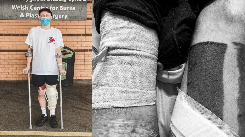 Homem de 31 anos quase perdeu parte da perna e até mesmo sua vida, após um simples arranhão provocado por uma queda na rua