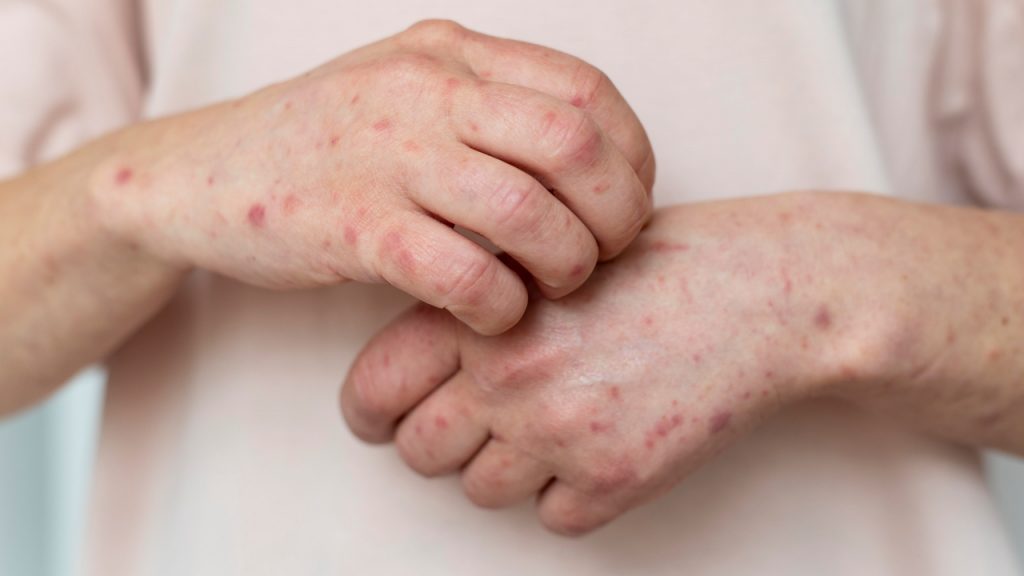 Segundo o Centro de Controle e Prevenção de Doenças dos EUA, casos se tornam ainda mais graves nos pacientes com problemas de pele prévios