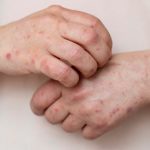 Segundo o Centro de Controle e Prevenção de Doenças dos EUA, casos se tornam ainda mais graves nos pacientes com problemas de pele prévios