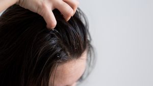 Tricologista alerta sobre sinais de inflamação no couro cabeludo e como identificar problema, além de destacar tratamento para fazer em casa!