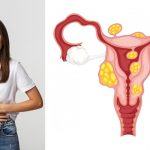O que são? São algum tipo de câncer? Como tratar? Ginecologista explica tudo que você precisa saber sobre os miomas uterinos!