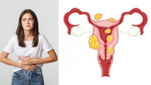 O que são? São algum tipo de câncer? Como tratar? Ginecologista explica tudo que você precisa saber sobre os miomas uterinos!