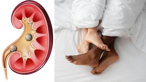 Ejaculação e orgasmo após sexo ou masturbação contraem bexiga que por sua vez auxilia a passagem das pedras dos rins pela uretra!