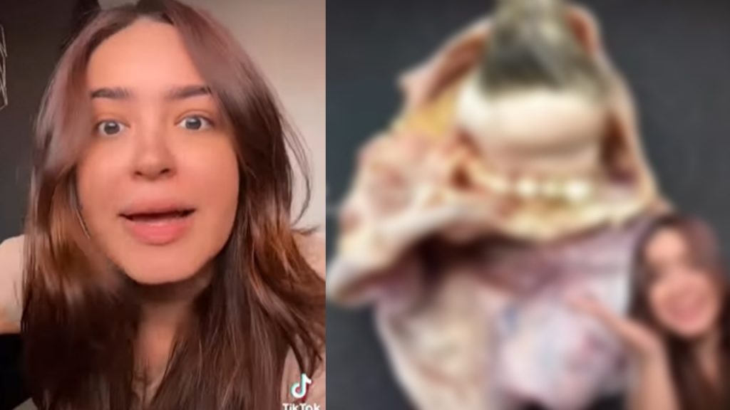 Tumor benigno pode ter dentes, pelos e até mesmo olhos, dependendo do tamanho; confira caso que viralizou no TikTok!