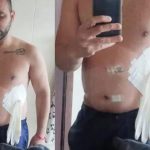 "Totalmente desrespeitado": Médico coloca luva cirúrgica ao invés de bolsa de colostomia em paciente