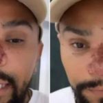 Naldo Benny sofre de necrose no nariz com rinomodelação: otorrino revela riscos do procedimento