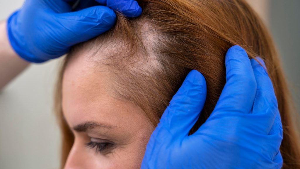 Alopecia: estudo identifica novo tipo de queda capilar por uso regular de escovas desembaraçantes