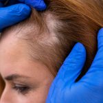 Alopecia: estudo identifica novo tipo de queda capilar por uso regular de escovas desembaraçantes